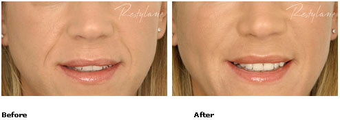 Restylane - Nasolabial Folds - Before & After Pictures