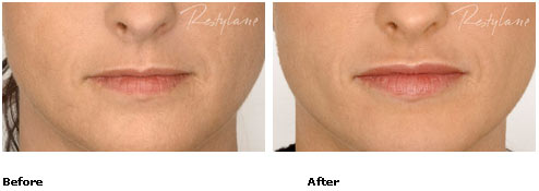 Restylane - Lips - Before & After Pictures
