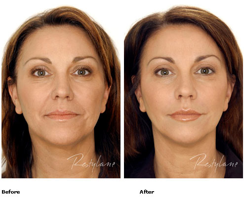 Restylane - Full Face - Before & After Pictures